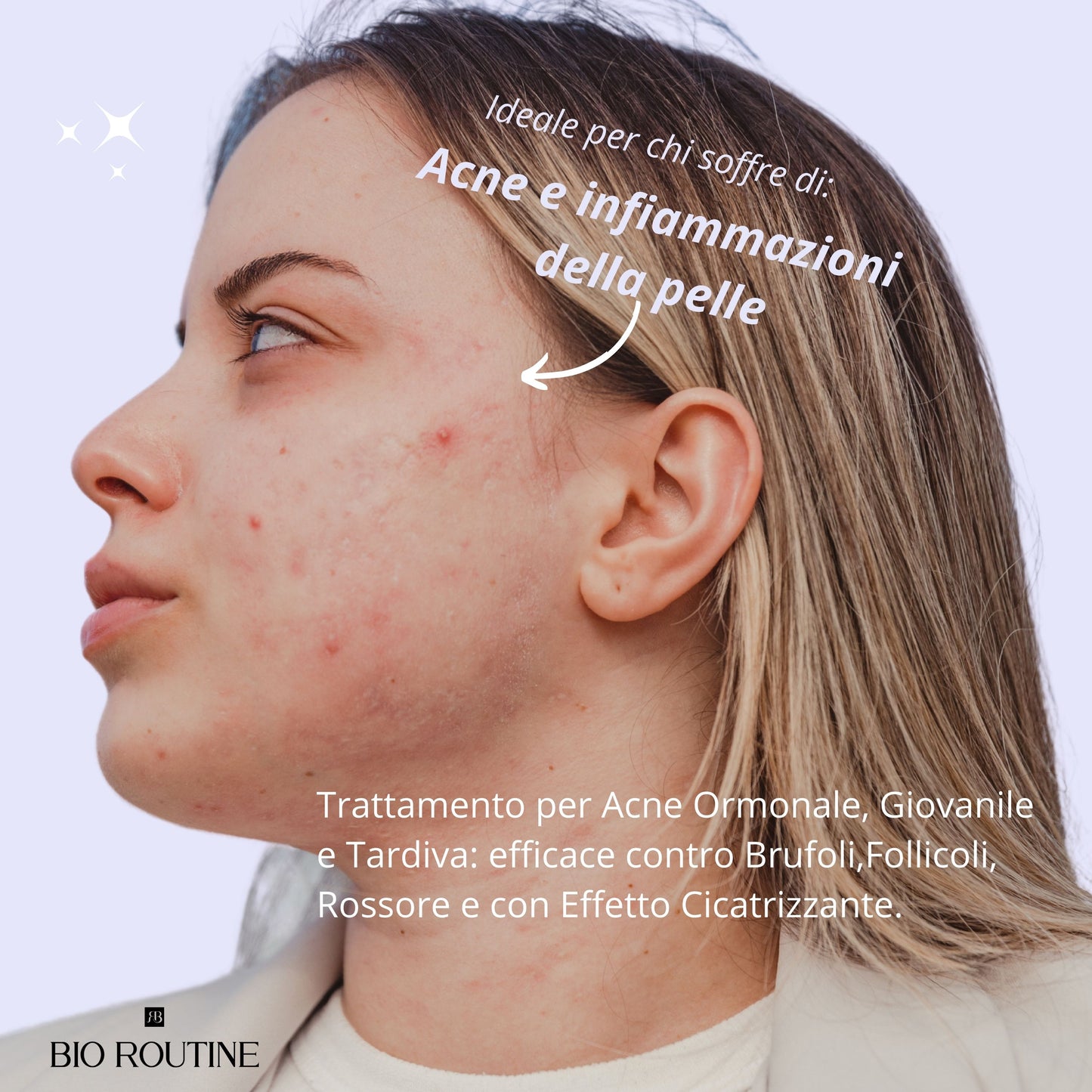 Acne Pro - Crema Anti Acne Viso