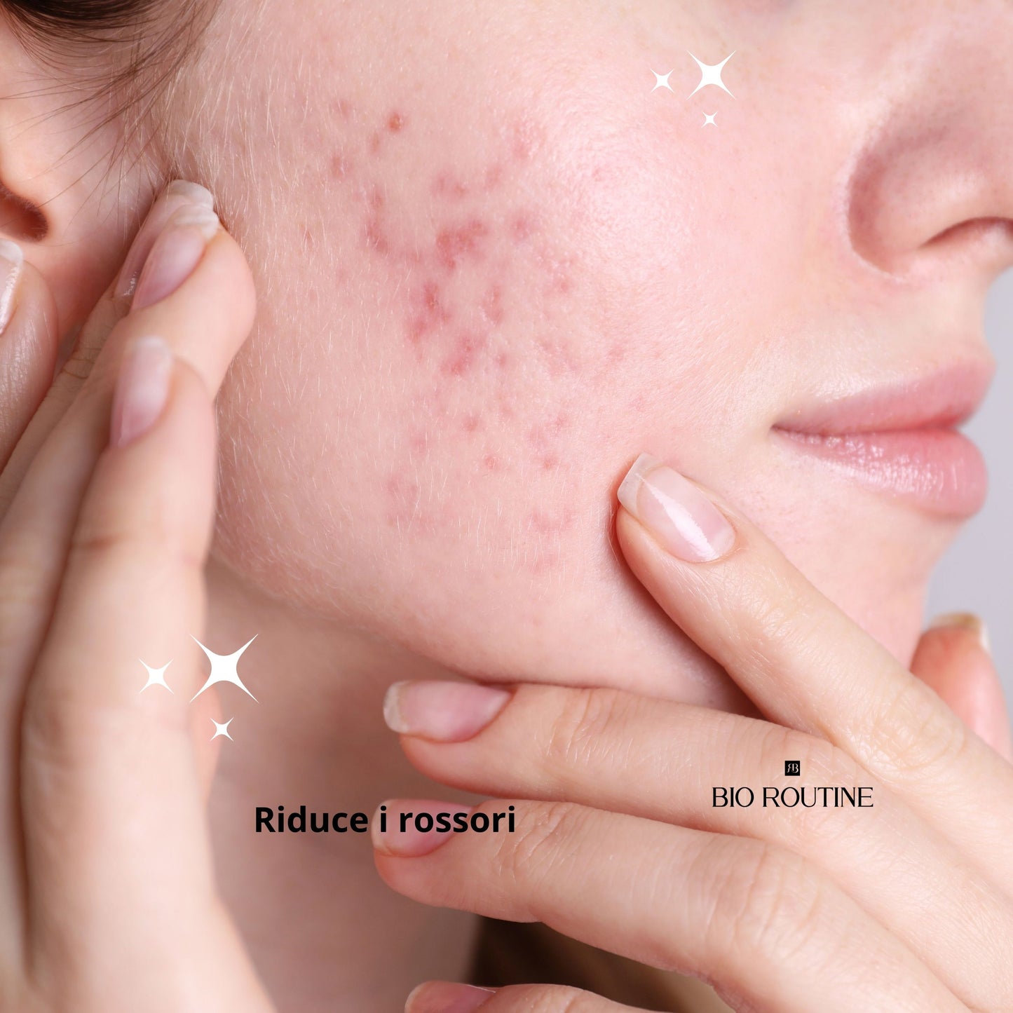 Acne Pro - Crema Anti Acne Viso